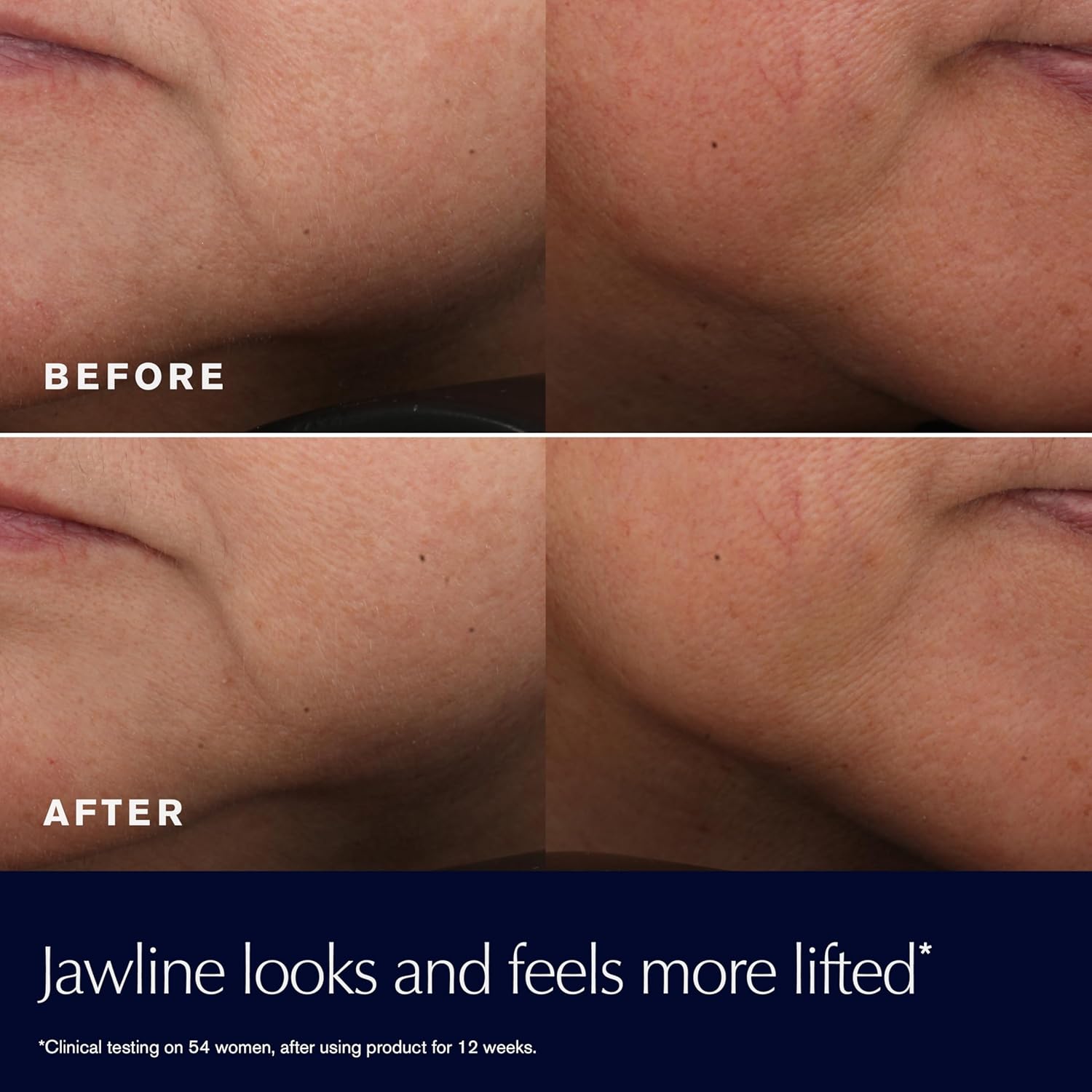 Before and after results showing lifted jawline after 12 weeks