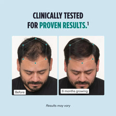Nutrafol Cilinically tested. "Before and after results of Nutrafol for men showing visible hair growth.